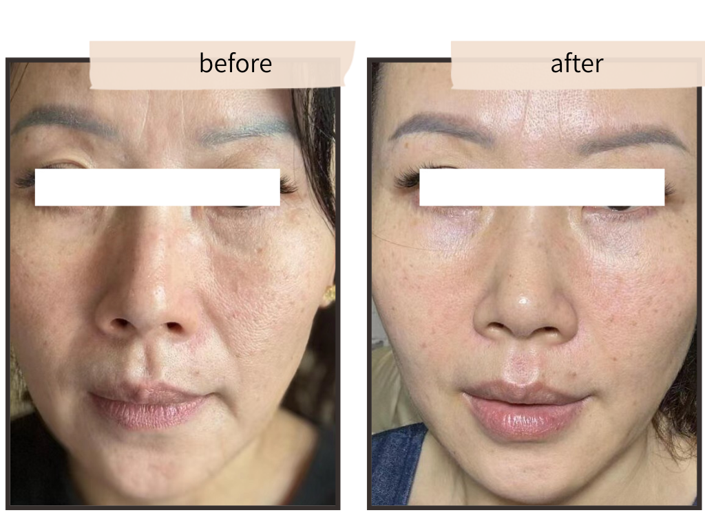 表情筋ケアの施術例